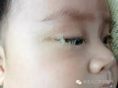 兒童兒淚囊炎的三種發病原因 兒童兒淚囊炎的三種發病原因