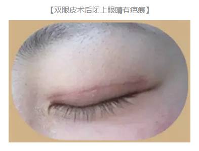 雙眼皮術后出現上瞼下垂怎么辦？