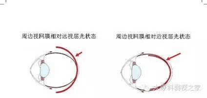 兒童近視防控中更應(yīng)重視離焦問(wèn)題