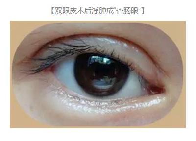 雙眼皮術后出現上瞼下垂怎么辦？