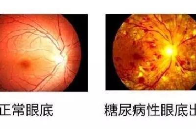 糖尿病會導致眼睛失明，視力模糊是前期征兆！