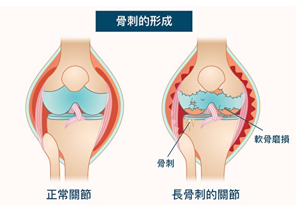 長骨刺有哪些原因？從中醫角度來看骨刺的預防與緩解方法