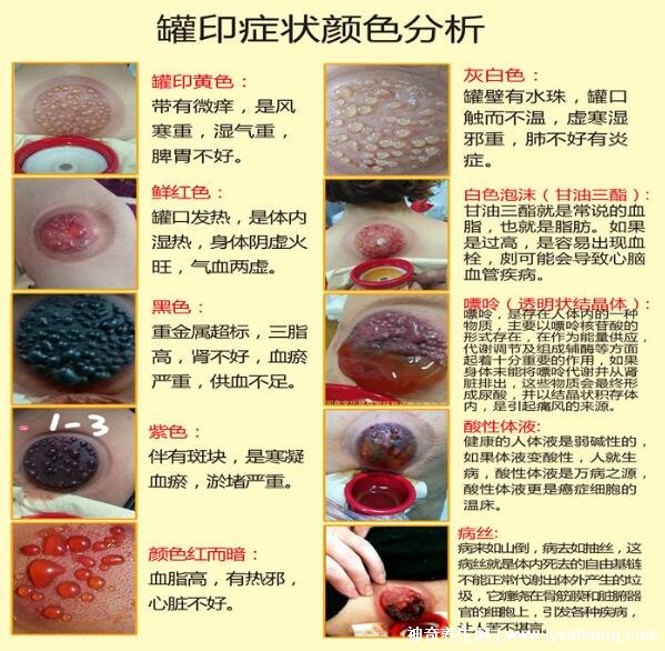 拔罐顏色癥狀對照表圖解，深淺代表不同病癥(越淺越好)