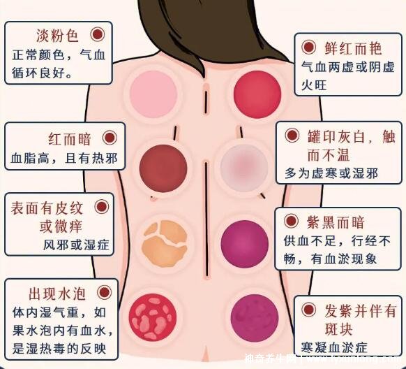 拔罐顏色癥狀對照表圖解，深淺代表不同病癥(越淺越好)