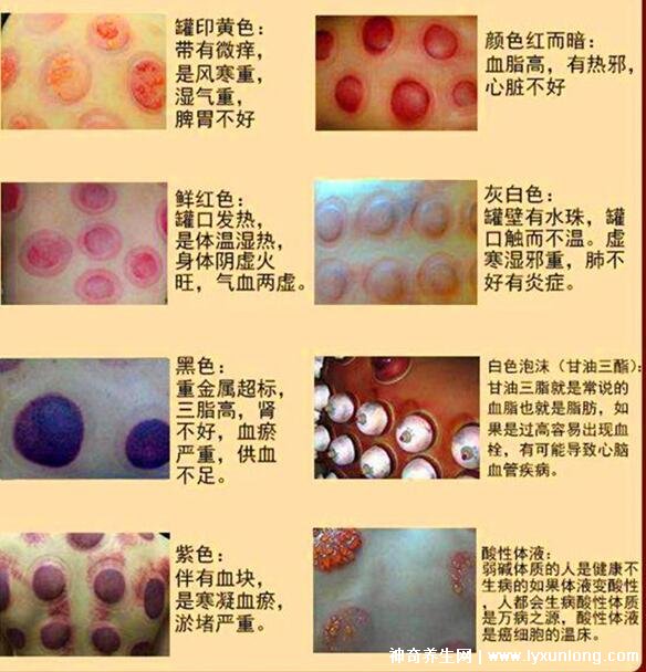 拔罐顏色癥狀對照表圖解，深淺代表不同病癥(越淺越好)